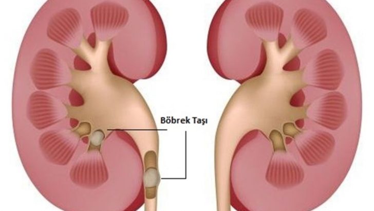 Böbrek Taşı Nasıl Oluşur?
