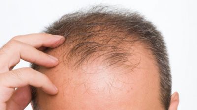 Minoksidil İle Erkeklerde Saç Dökülmesi Nasıl Önlenir?
