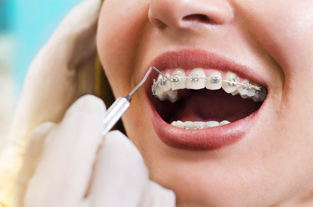 Ortodonti Nedir?