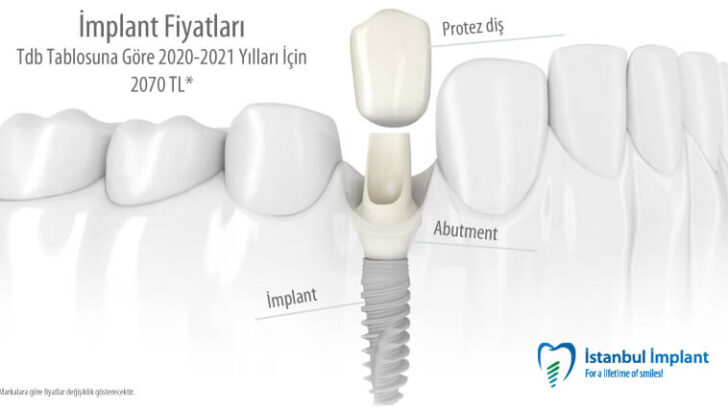 İmplant Fiyatları Nasıl Hesaplanır?