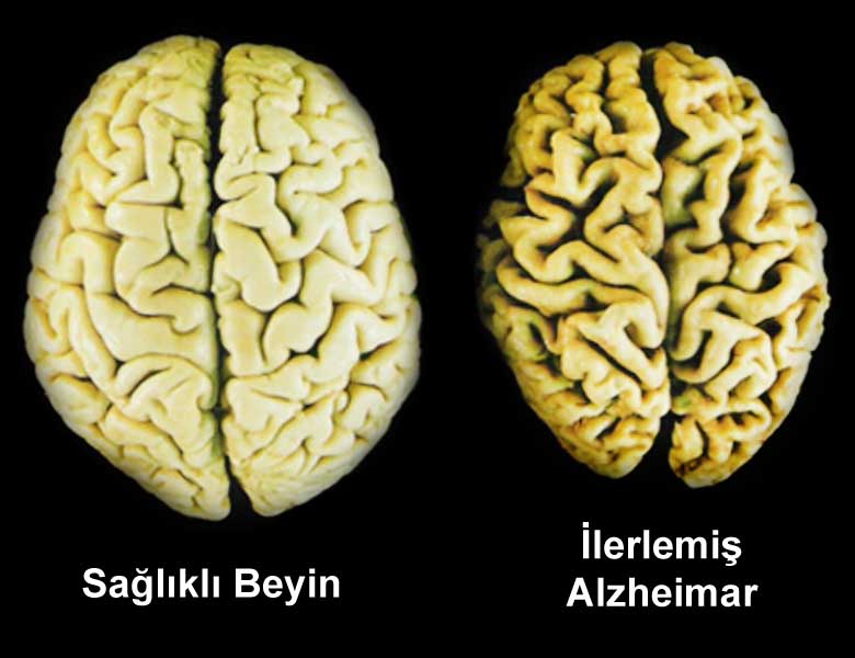 Alzheimer nedir?