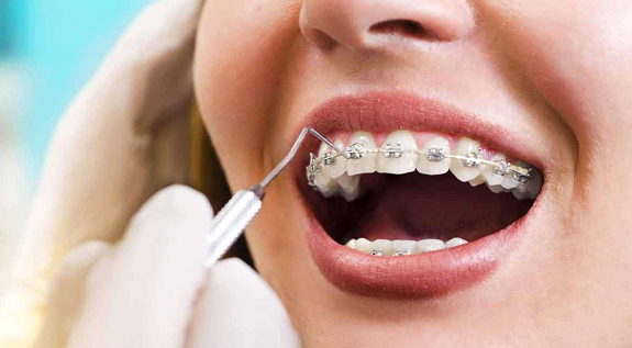 Ortodontik Tedavi Nedir?
